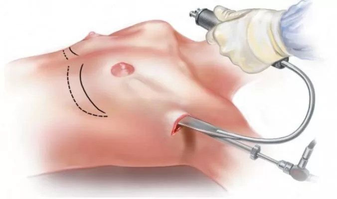 Ưu điểm nâng ngực nội soi là gì? Nâng ngực nội soi là gì?