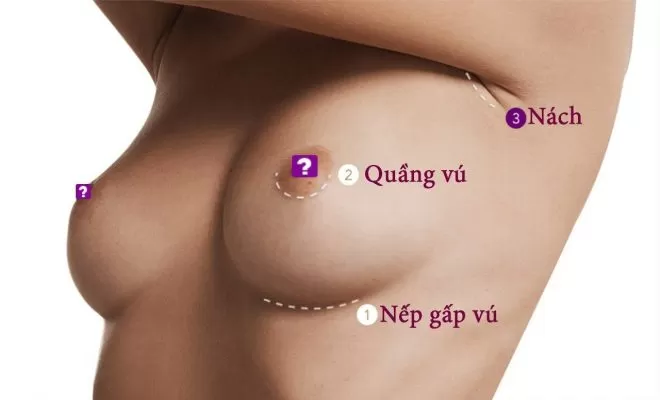Ưu điểm nâng ngực nội soi là gì? Ưu điểm nâng ngực nội soi