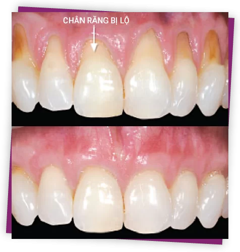 Phẫu thuật ghép nướu khi bị tụt nướu phau thuat ghep nuou khi bi tut nuou