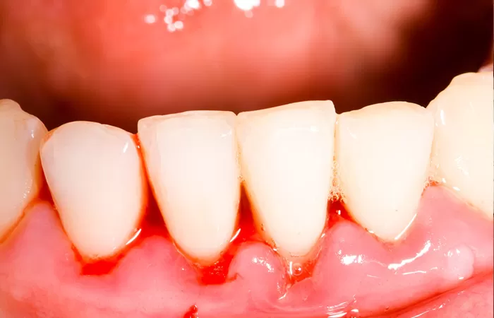 Nguyên nhân và cách điều trị chảy máu chân răng hiệu quả chay mau chan rang