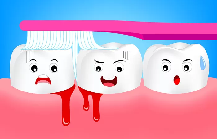 Nguyên nhân và cách điều trị chảy máu chân răng hiệu quả chay mau chan rang
