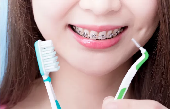 Niềng răng bao nhiêu tiền? 3 Yếu tố quyết định chi phí niềng răng? nieng rang bao nhieu tien