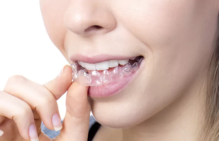 Niềng răng bao nhiêu tiền? 3 Yếu tố quyết định chi phí niềng răng? nieng rang bao nhieu tien