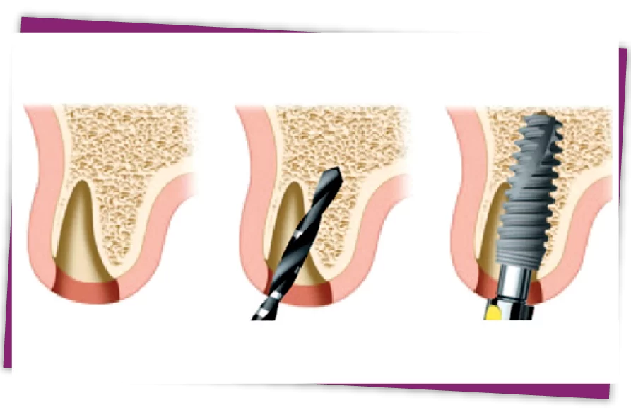 Đặt Implant tức thì sau nhổ răng Implant tức thì