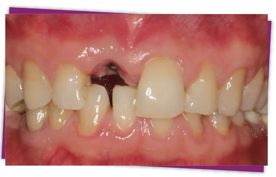 Đặt Implant tức thì sau nhổ răng Implant tức thì