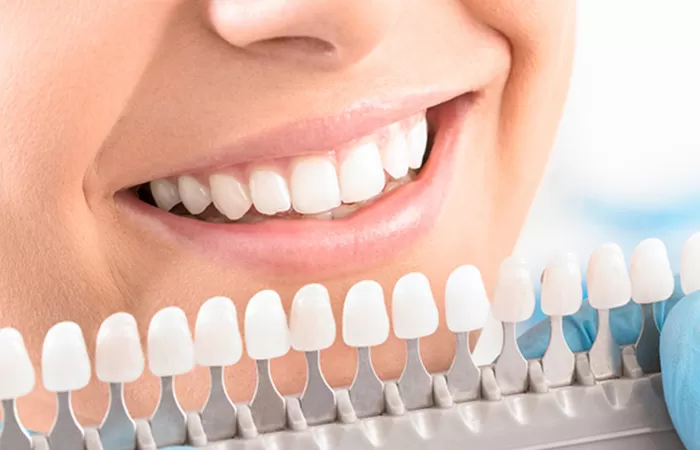 Bọc răng sứ giá rẻ tại TPHCM - Nên hay không? bọc răng sứ giá rẻ tại TPHCM
