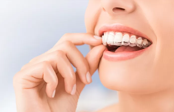 Niềng răng trong suốt giá bao nhiêu? Có đắt không? Niềng răng trong suốt là gì