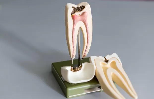 ĐIỀU TRỊ TỦY RĂNG TRONG NHỮNG CA KHÓ Dieu tri tuy rang