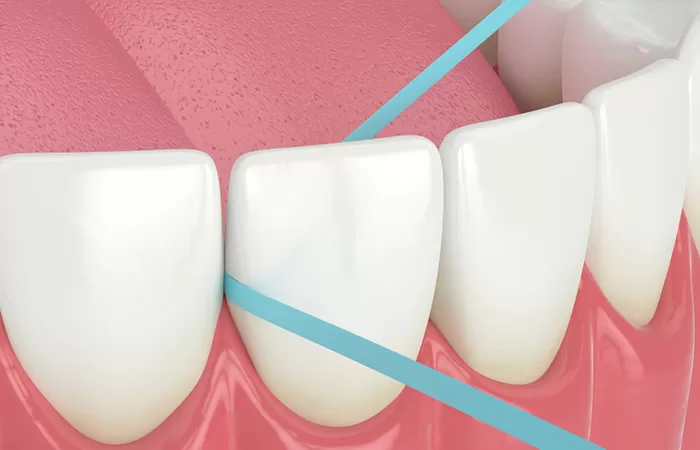 Răng sứ là gì? Trường hợp nào nên bọc răng sứ? răng sứ