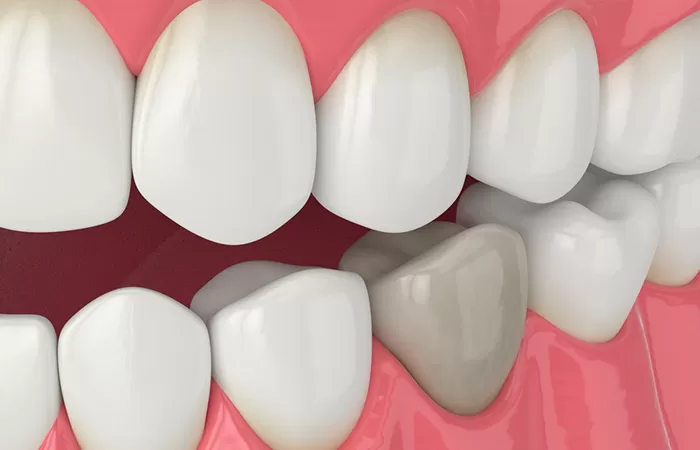 Răng sứ là gì? Trường hợp nào nên bọc răng sứ? răng sứ