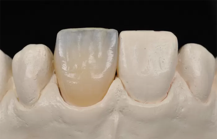 Các phương pháp bọc răng sứ hiện nay – Cập nhật 2021 cac phuong phap bọc rang su hien nay