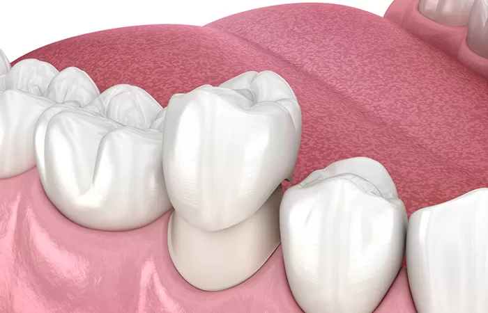 Răng sứ là gì? Trường hợp nào nên bọc răng sứ? răng sứ