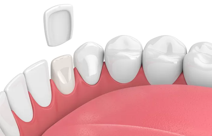 Các phương pháp bọc răng sứ hiện nay – Cập nhật 2021 cac phuong phap bọc rang su hien nay
