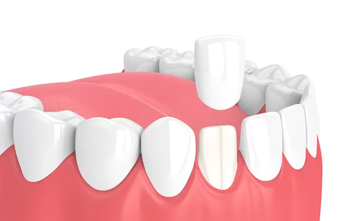 Các phương pháp bọc răng sứ hiện nay – Cập nhật 2021 cac phuong phap bọc rang su hien nay