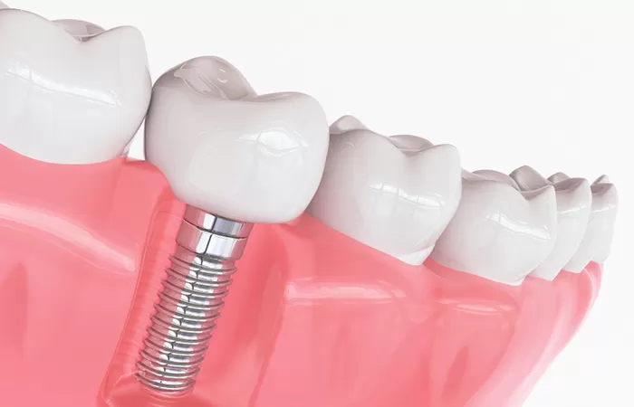 Trồng răng implant - Giải pháp hàng đầu cho người mất răng lâu năm trong rang implant