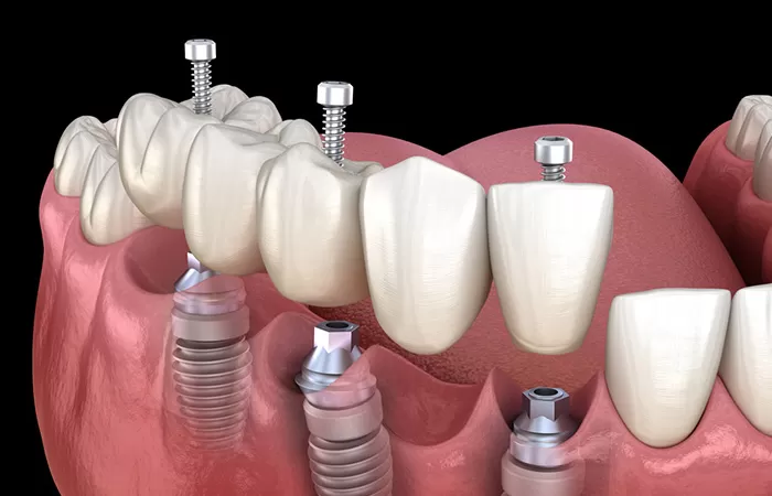 Trồng răng implant - Giải pháp hàng đầu cho người mất răng lâu năm trong rang implant