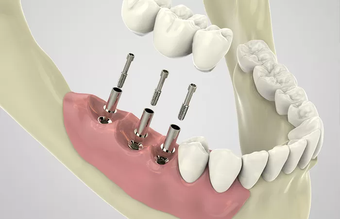 Trồng răng implant - Giải pháp hàng đầu cho người mất răng lâu năm trong rang implant