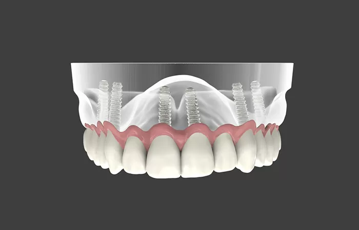 Trồng răng implant - Giải pháp hàng đầu cho người mất răng lâu năm trong rang implant