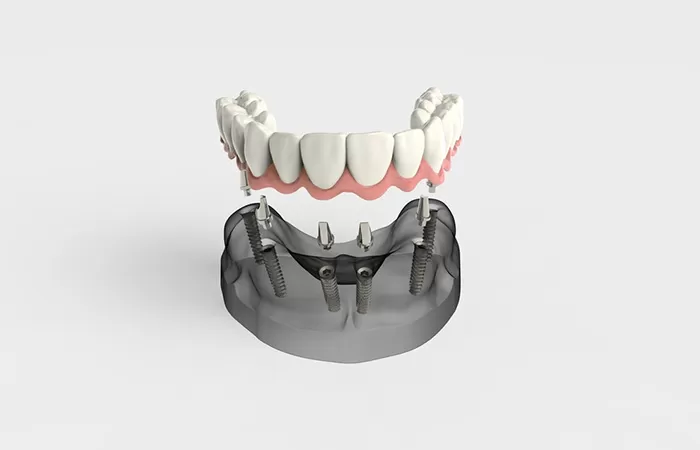 Trồng răng implant - Giải pháp hàng đầu cho người mất răng lâu năm trong rang implant