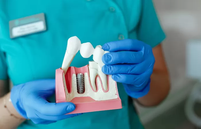 Trồng răng implant - Giải pháp hàng đầu cho người mất răng lâu năm trong rang implant
