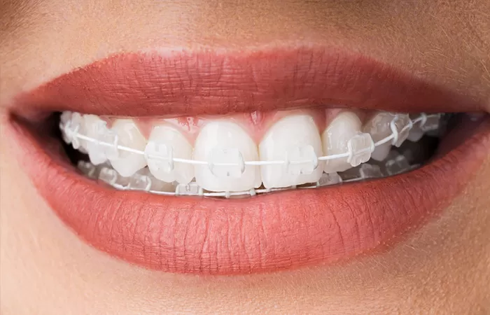 Liệt kê đặc điểm các loại niềng răng phổ biến hiện nay cac loai nieng rang pho bien hien nay