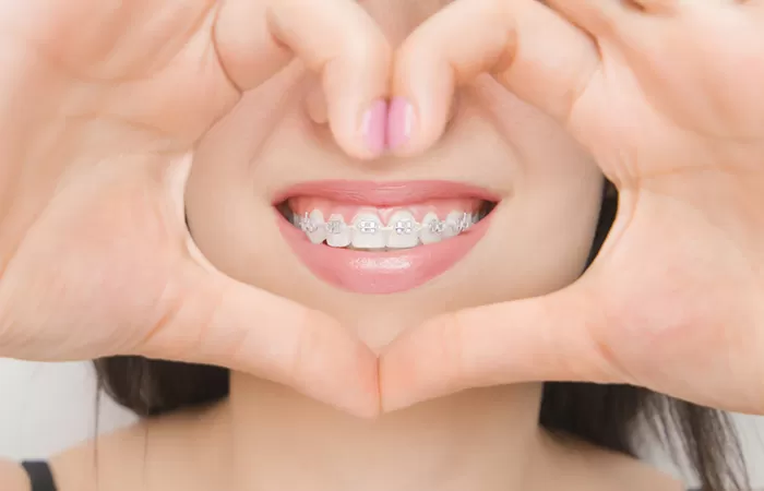 Niềng răng mặt trong là gì? Áp dụng với trường hợp nào? cac loai nieng rang pho bien hien nay