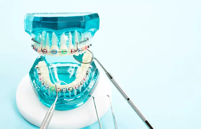 Liệt kê đặc điểm các loại niềng răng phổ biến hiện nay cac loai nieng rang pho bien hien nay