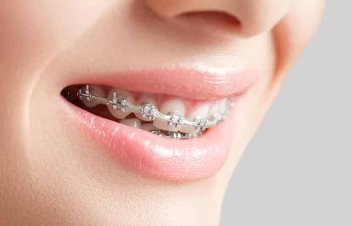 Liệt kê đặc điểm các loại niềng răng phổ biến hiện nay cac loai nieng rang pho bien hien nay