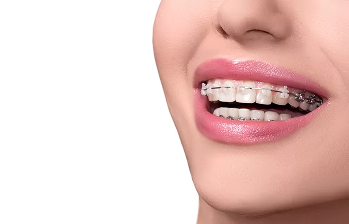Liệt kê đặc điểm các loại niềng răng phổ biến hiện nay cac loai nieng rang pho bien hien nay