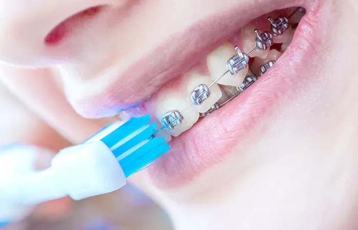 Liệt kê đặc điểm các loại niềng răng phổ biến hiện nay cac loai nieng rang pho bien hien nay