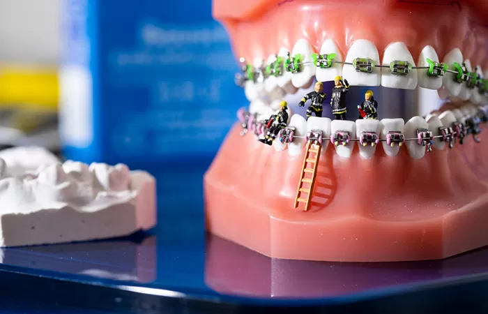 Liệt kê đặc điểm các loại niềng răng phổ biến hiện nay cac loai nieng rang pho bien hien nay