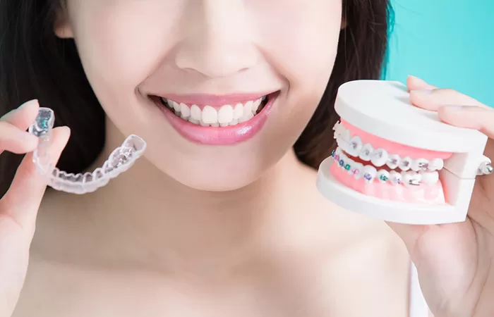 Liệt kê đặc điểm các loại niềng răng phổ biến hiện nay cac loai nieng rang pho bien hien nay
