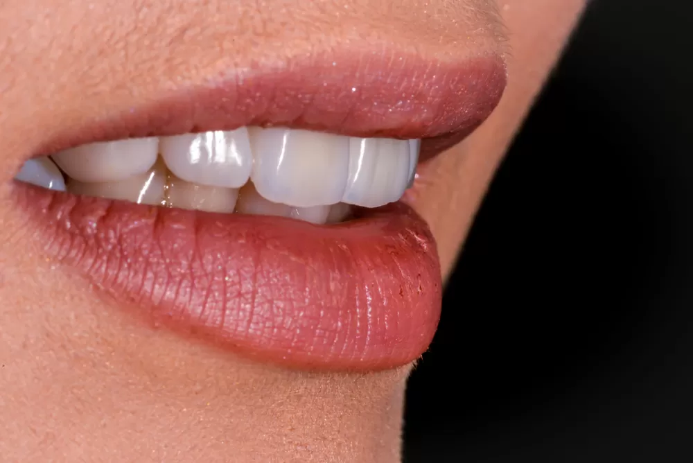 Tất tần tật những điều cần biết về răng sứ Zirconia rang-toan-su-zirconia