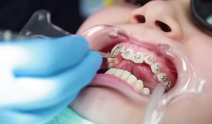 Hỏi & Đáp: Niềng răng móm bao nhiêu tiền? Có đắt không? Niềng răng móm