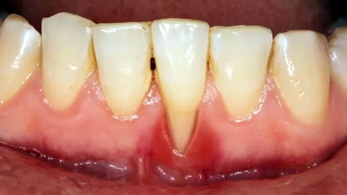 Sự khác biệt giữa nha khoa giá rẻ và nha khoa cao cấp hậu quả của nha khoa giá rẻ