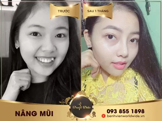 Nâng mũi sụn Surgiform giá bao nhiêu? kết quả nâng mũi
