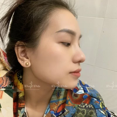 Nâng mũi cấu trúc là gì nâng mũi cấu trúc