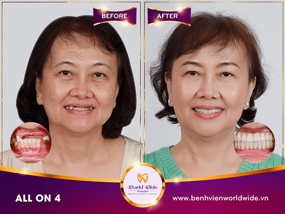 Gallery khách trồng răng implant all on 6 (10)