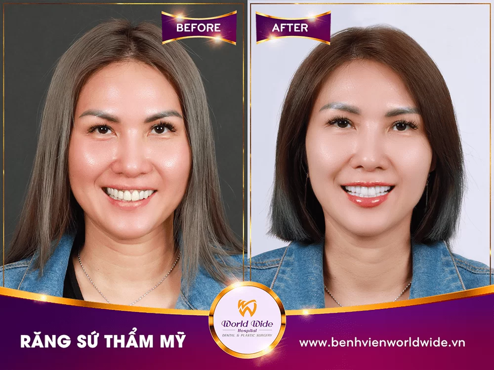 Gallery răng sứ thẩm mỹ (18)