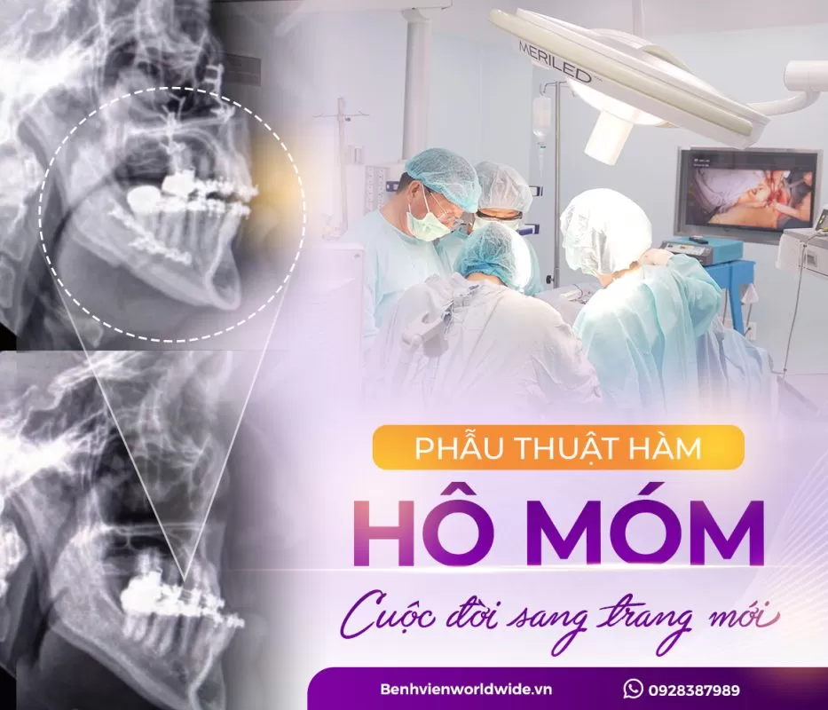 Phẫu thuật chỉnh móm - Chỉnh 1 lần đẹp trọn đời | Worldwide hô móm
