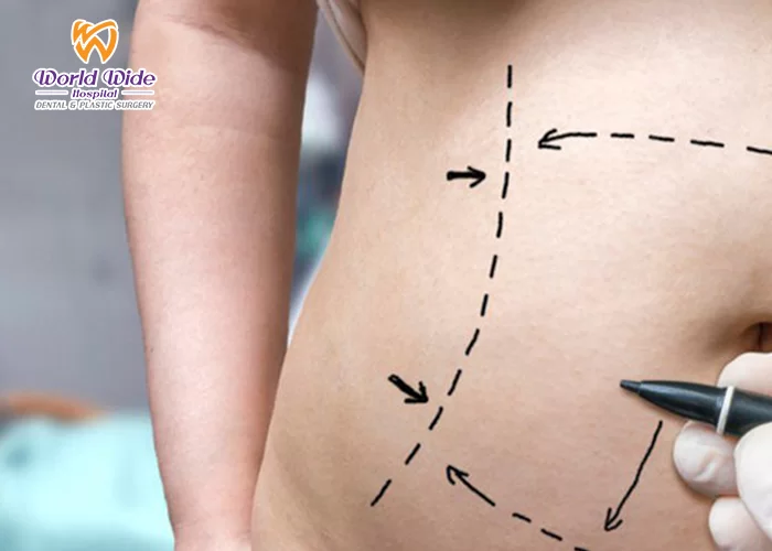 Bảng giá hút mỡ hút mỡ tại hình thành bụng
