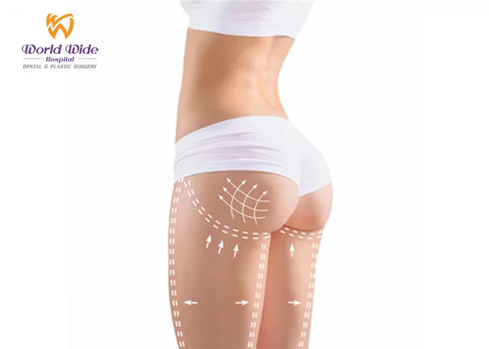 Bảng giá hút mỡ thẩm mỹ mông