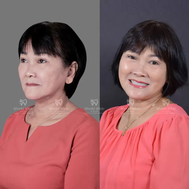 TRỒNG RĂNG IMPLANT TOÀN HÀM Mất răng toàn hàm