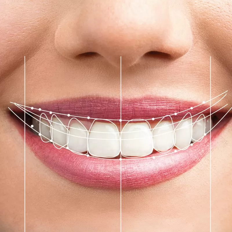 TRỒNG RĂNG IMPLANT TOÀN HÀM phần mềm phân tích nụ cười