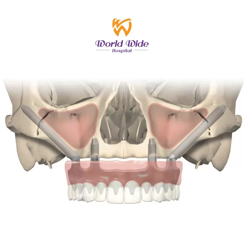 GIỚI THIỆU VỀ ZYGOMA IMPLANT zygoma-implant