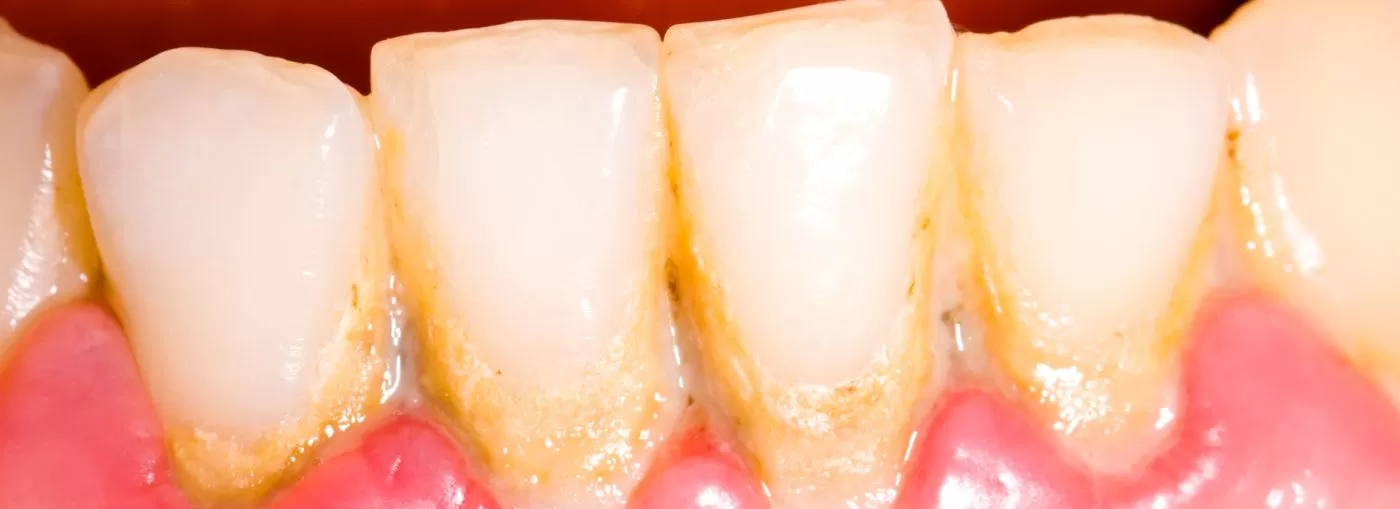 Điều trị bệnh nha chu hậu quả của viêm nha chu