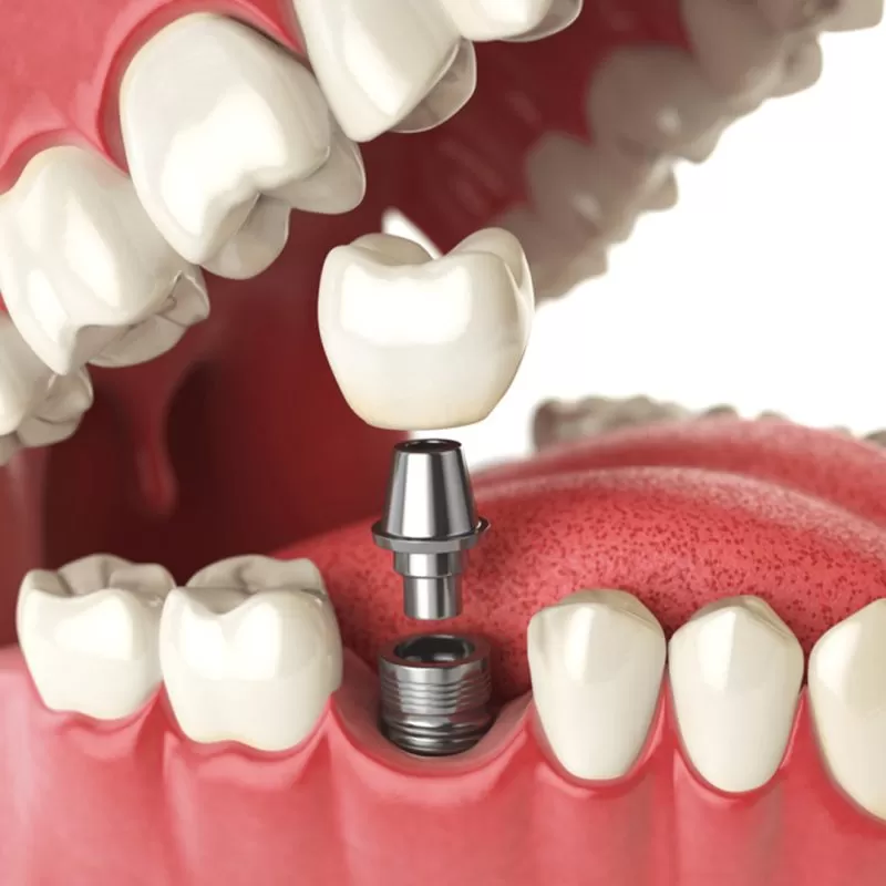 Quy trình cấy ghép Implant đặt trụ lành thương implant