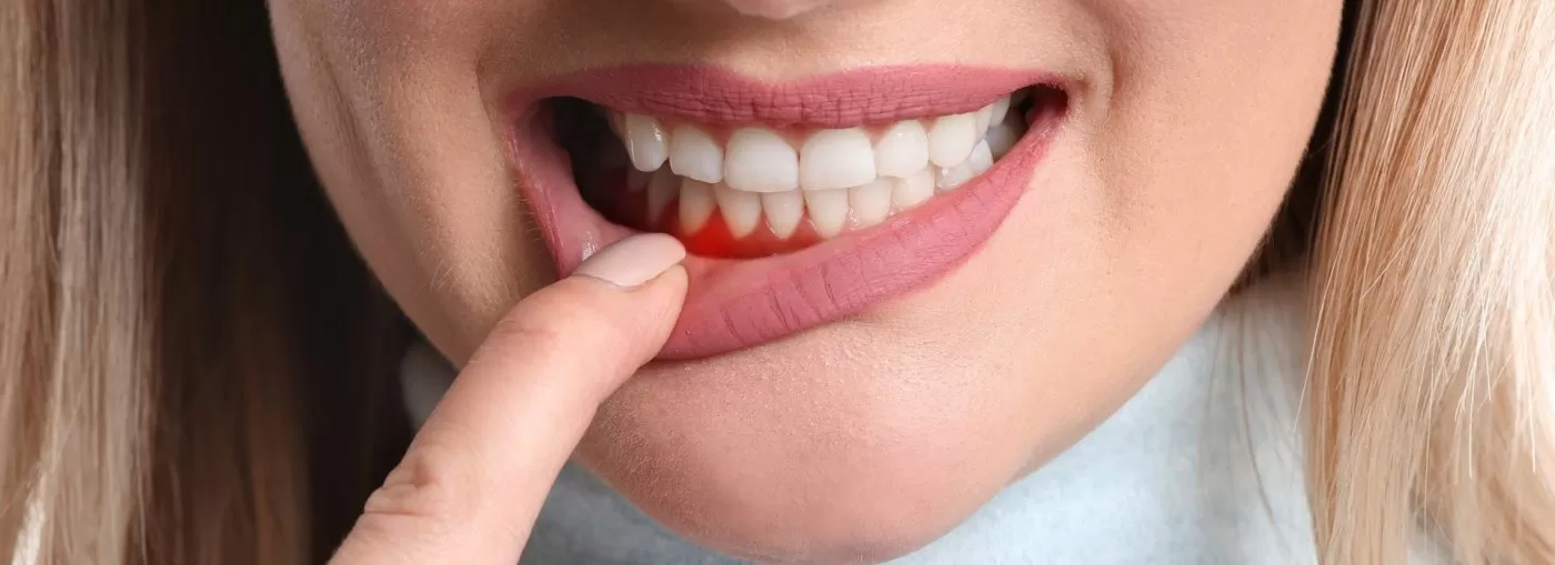 Điều trị bệnh nha chu viêm nha chu