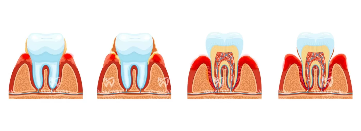Điều trị bệnh nha chu bệnh nha chu là gì