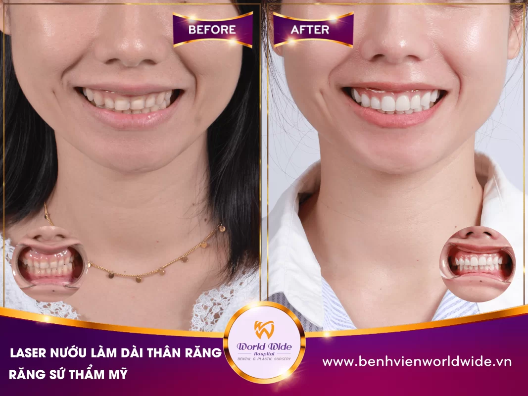 KHẮC PHỤC TÌNH TRẠNG RĂNG NGẮN, MÒN VẸT VÀ CƯỜI LỘ NƯỚU TẠI Kubet RHM WORLDWIDE BF_AT_T4_2024_thi anh dao-min